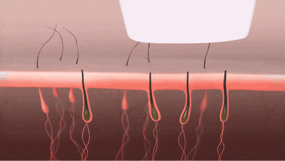 兩種脫毛儀-808orOPT，你會(huì)如何選